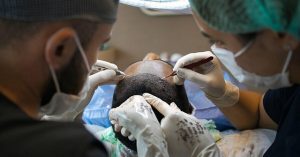 fusehairdelhi1 hair transplant g6368626eb 640