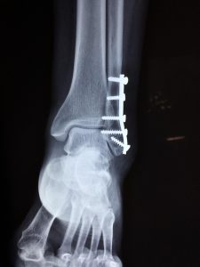 taokinesis ankle gfa8fe5e5b 640